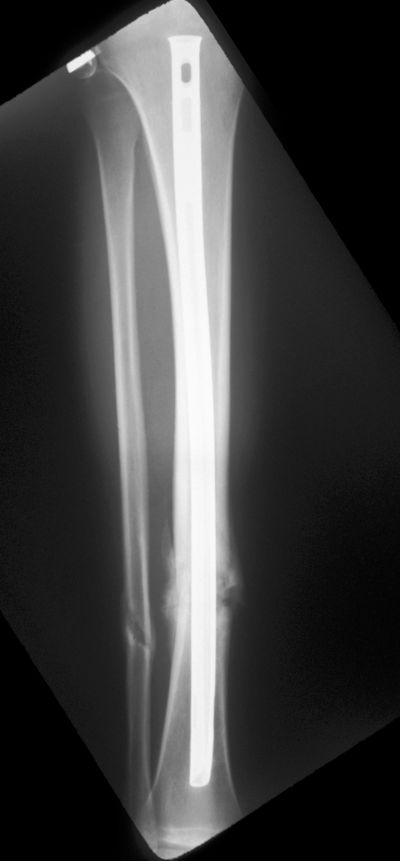 Tibia, Shaft:  Synthes Universal Tibial Nail (Implant 235)